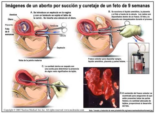 aborto esto es legal