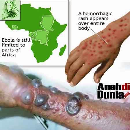 foto-korban-virus-ebola