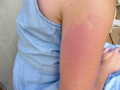 Getting-a-COVID-arm-rash-after-the-Moderna-vaccine-might-be-itchy-but-its-no-big-deal