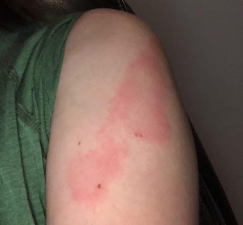 b822bfe6-60d1-45d8-9275-f1245d96411c-COVID_rash