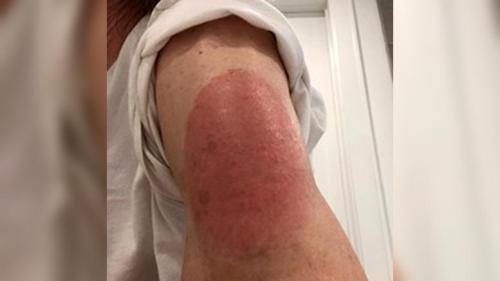 Skin-Reaction-to-Moderna-COVID-19-Vaccine