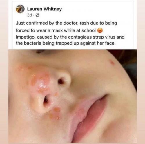 Impetigo from wearing a face mask