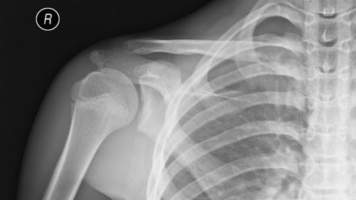 aafishshoulderevolution_1000x563